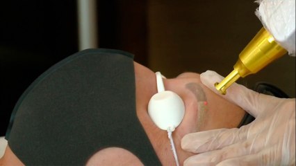 bd-laser-para-remover-microblading-210721