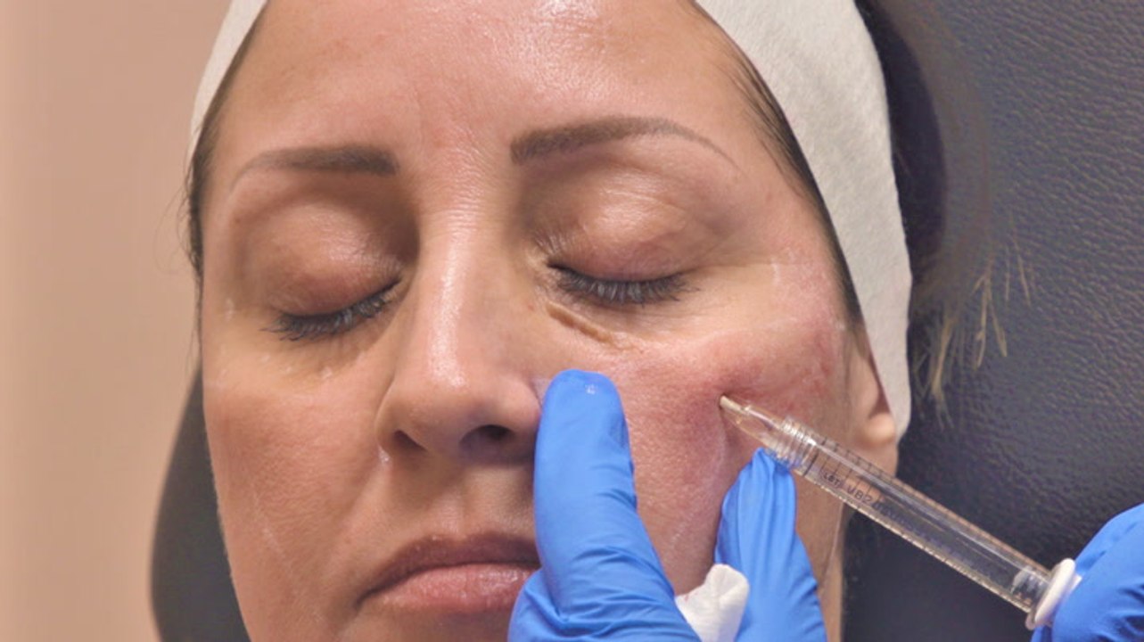 How different facial fillers work