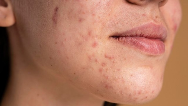 Cara Mudah Menghilangkan Bekas Jerawat di Wajah