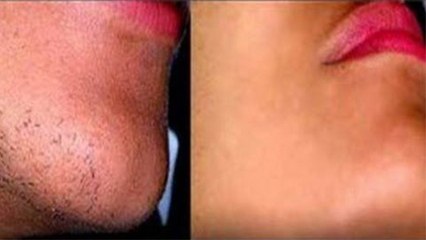 Chin के Unwanted Hair हमेशा के लिए हटाएं, बस अपनाएं ये घरेलू उपचार । Boldsky