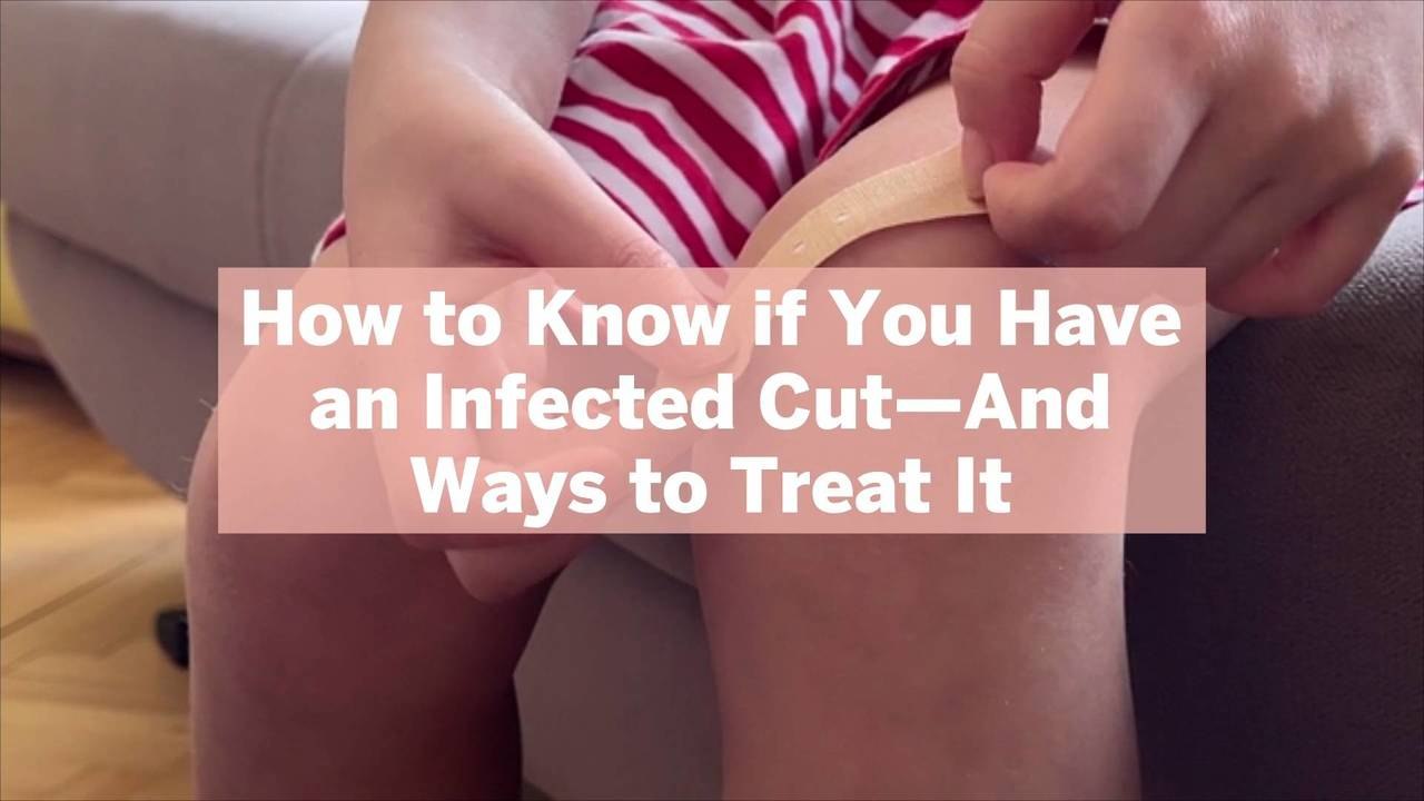 How to Know if You Have an Infected Cut—And Ways to Treat It - video ...