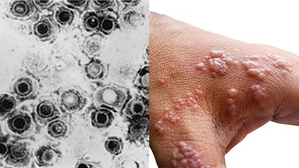 Herpes-B Virus है बेहद खतरनाक जानें इसके Symptoms और कैसे करें इससे बचाव | Boldsky