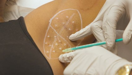 3 different ways to use Botox