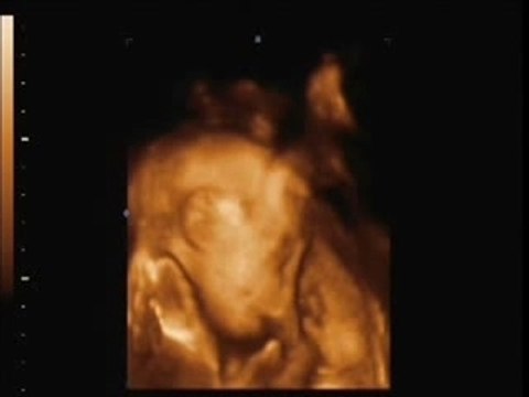 4D Baby Ultrasound Scan with the whole family