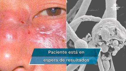 Reportan tercer caso sospechoso de Hongo Negro por Covid-19 en Oaxaca; ahora en la Cuenca