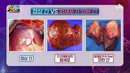 ∑⊙□⊙전조 증상이 없어서 더 무섭다! 침묵의 장기, 간!