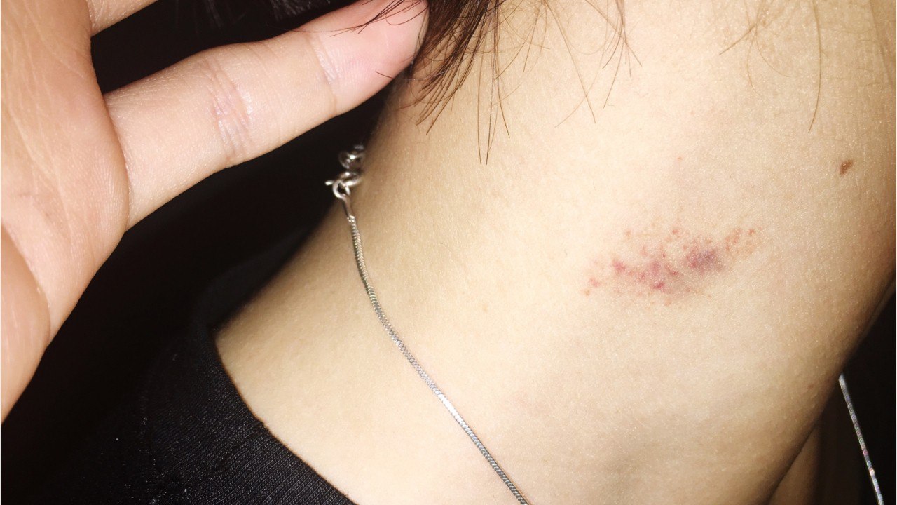 Six Ways To Get Rid of a Hickey That Actually Work
