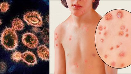 Corona Delta Variant क्या Chickenpox जितनी आसानी से फैलेगा, CDC का दावा | Boldsky