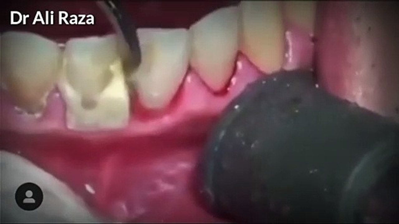 Best Way To Remove Tartar From Teeth