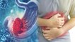 पेट का कैंसर क्या होता है, जानें लक्षण और बचाव | Stomach Cancer Symptoms and Treatment | Boldsky