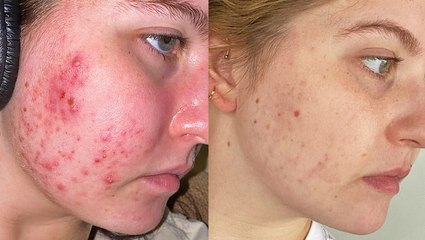 My 8-month Accutane journey with side effects and results