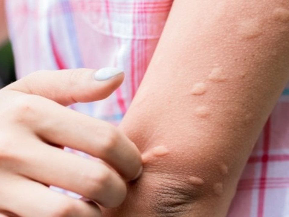 Schluss mit Kratzen: Diese Pflanzen helfen gegen Mücken