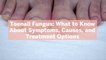 Toenail Fungus: What to Know About Symptoms, Causes, and Treatment Options, According to E