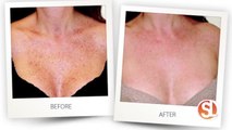 Reduce dark spots and reduce wrinkles with intense pulse light at Turn Back Time Spa & Wellness Clinic