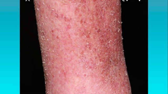 bd-lesiones-mas-comunes-en-la-piel-de-adultos-mayores-030821