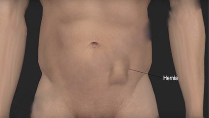 पेट के निचले हिस्से में दर्द हो सकता है Hernia, जानें क्या हैं इसके Symptoms | Boldsky