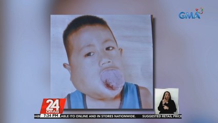 6-anyos na batang may malaking dila, nangangailangan ng tulong para sa kanyang gamutan at operasyon | 24 Oras