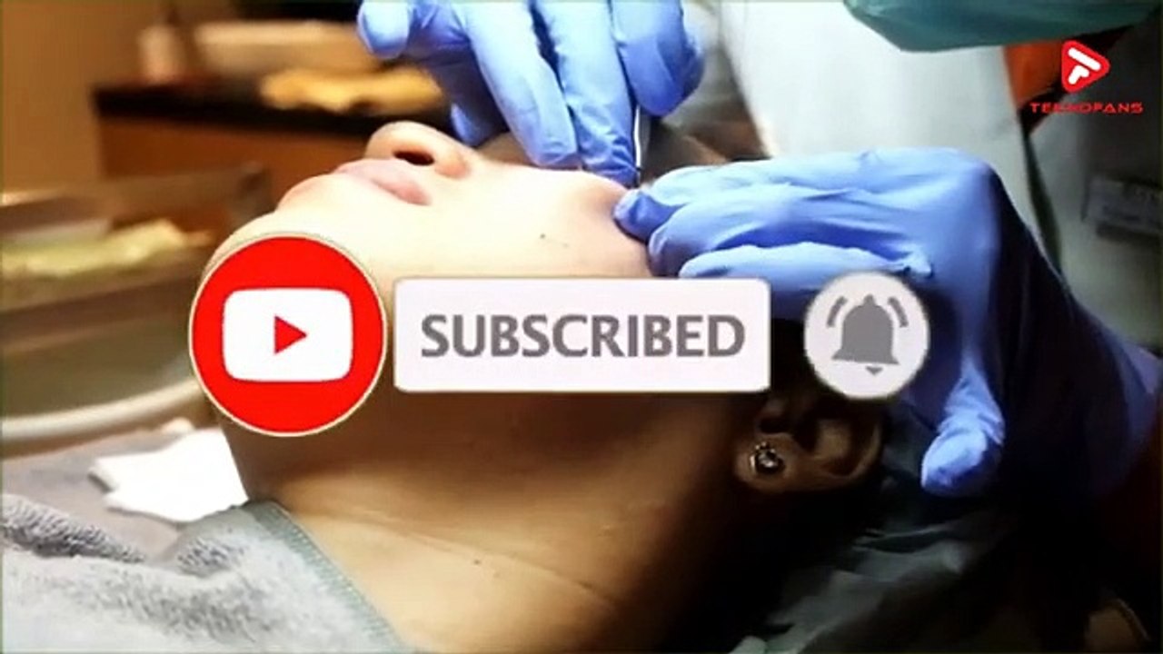 JANGAN DIPENCET INILAH 5 CARA CEPAT MENGHILANGKAN KOMEDO SECARA ALAMI