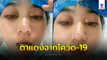 สาวรีวิวอาการตาแดงจากการติดเชื้อ โควิด-19