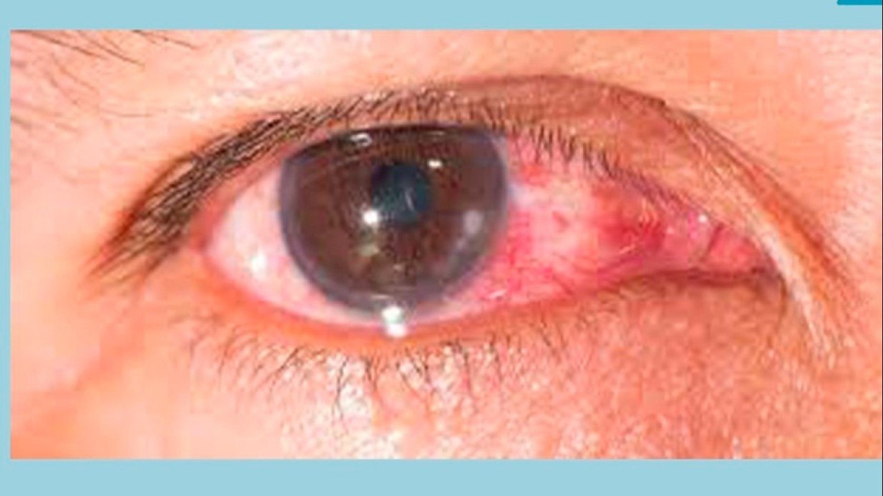 bd-diabetes-y-sus-repercusiones-en-la-salud-de-los-ojos-100821