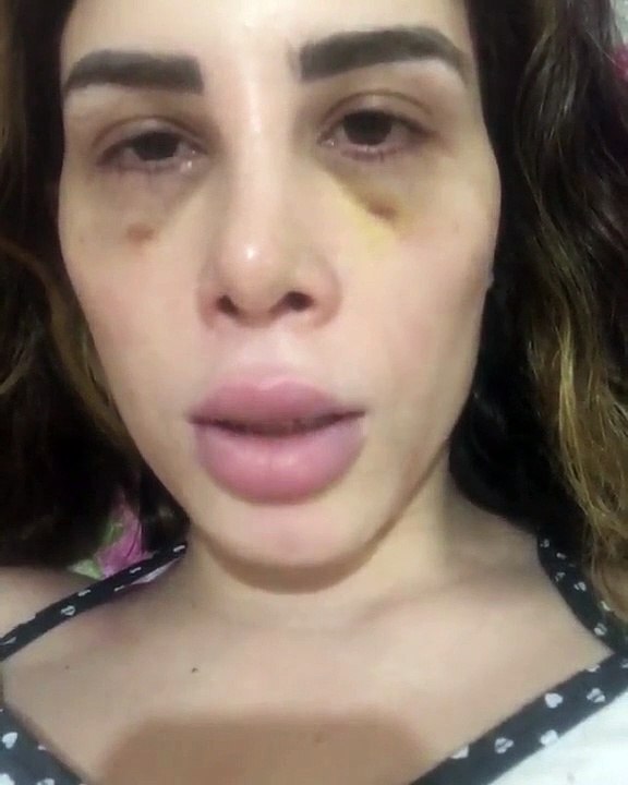 Youtuber brasileira fica sem andar após infecção em prótese de silicone
