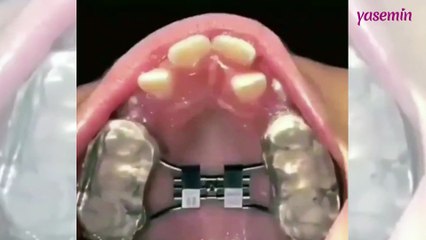 Hızlandırılmış ortodontik tedavisinin muazzam etkisi