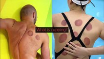 'Cupping'. A nova técnica dos atletas olímpicos que está a causar espanto