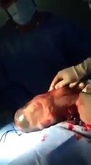 Um caso raro: este bebé nasceu sem romper a bolsa amniótica