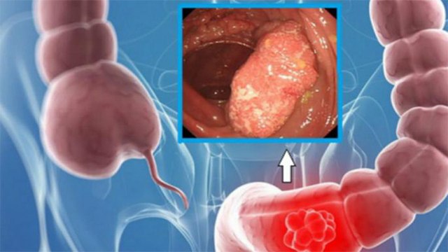 Liver में घाव Ulcerative Colitis एक गंभीर समस्या,समय रहते ऐसे करें पहचान । Boldsky