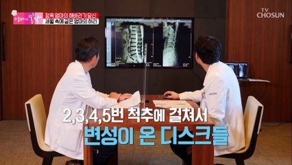 구부정한 허리가 반듯! ˹내시경 감압술˼로 달라진 엄마 TV CHOSUN 20210815 방송
