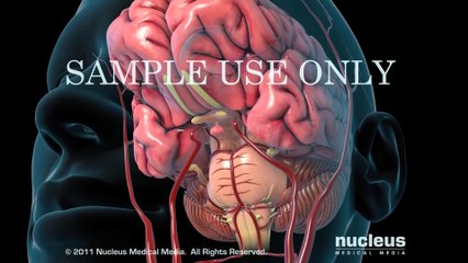 Stroke  Nucleus Health