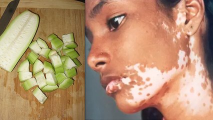 लौकी की सब्जी के साथ भूलकर ना खाएं ये 2 चीज, सफेद दाग का खतरा | Boldsky