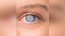 मोतियाबिंद क्यों होता है जानिए आंखो से जुड़ी इस परेशानी के  लक्षण और कारण । Boldsky