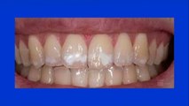 bd-manchas-blancas-en-los-dientes-170821