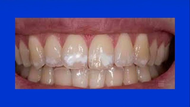 bd-manchas-blancas-en-los-dientes-170821