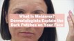 What Is Melasma? Dermatologists Explain the Dark Patches on Your Face—And How to Treat Them
