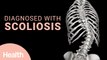 What is Scoliosis? Effects of a Scoliosis Diagnosis & Life After Spinal Fusion Surgery