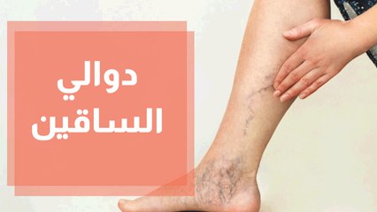 دوالي الساقين احد الامراض المحرجة