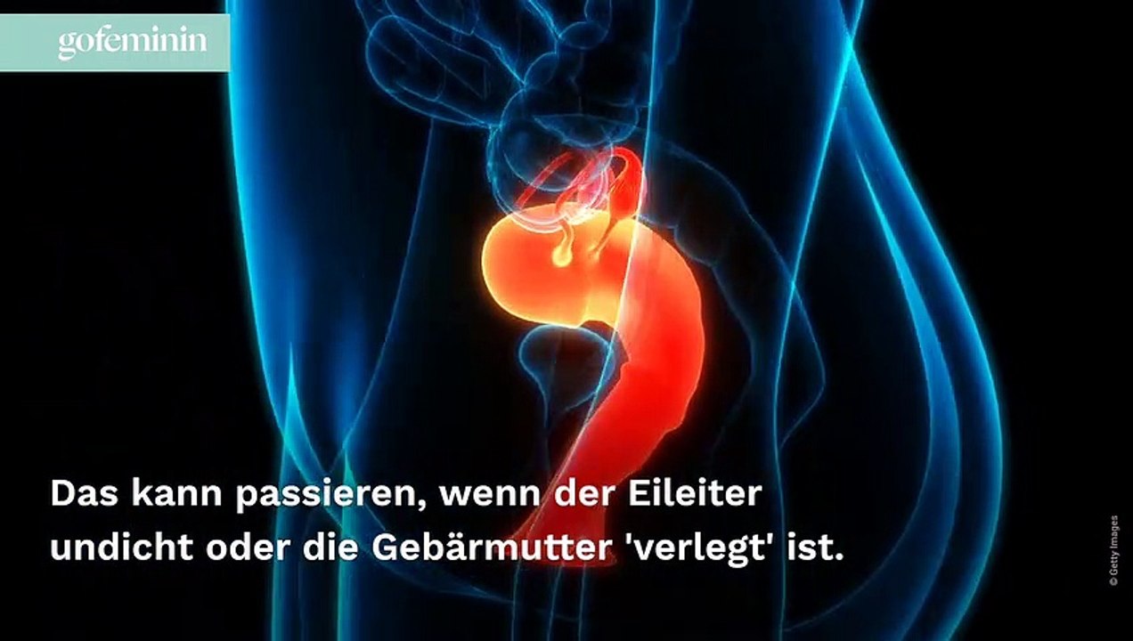 Bauchhöhlenschwangerschaft: Was ihr dazu wissen solltet