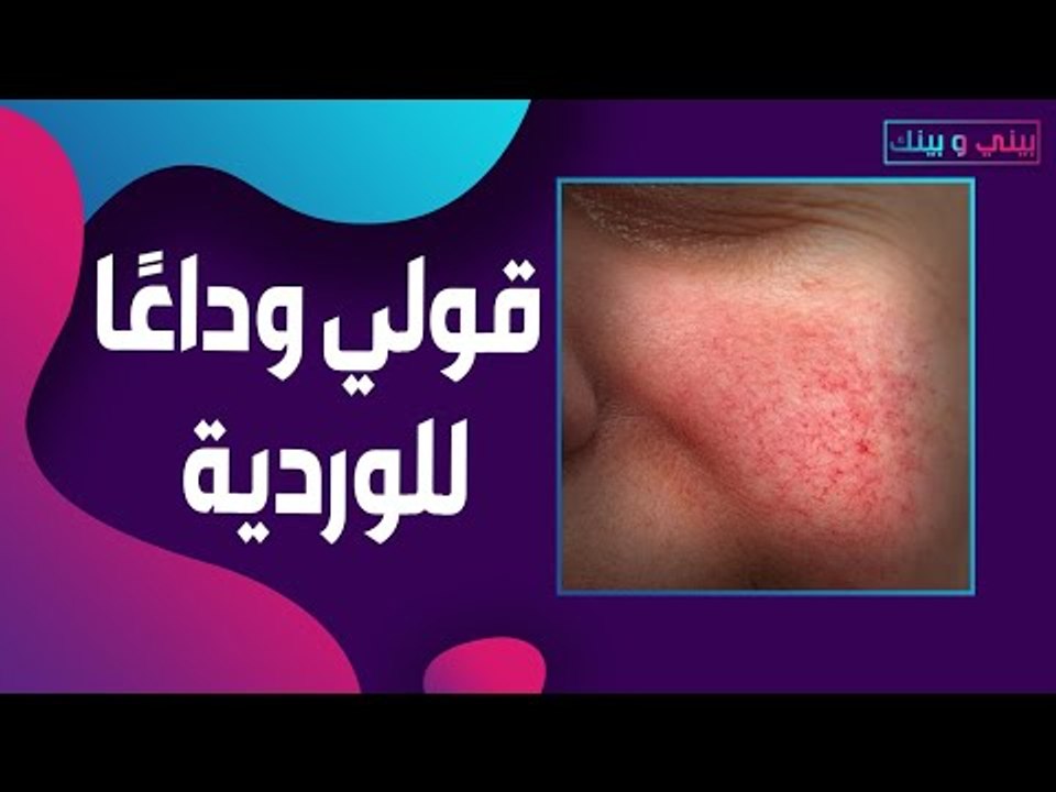 الوردية تخفي جمالك وتبديك اكبر سنًا! عالجيها بهذه النصائح الطبيعية وغير المكلفة ..