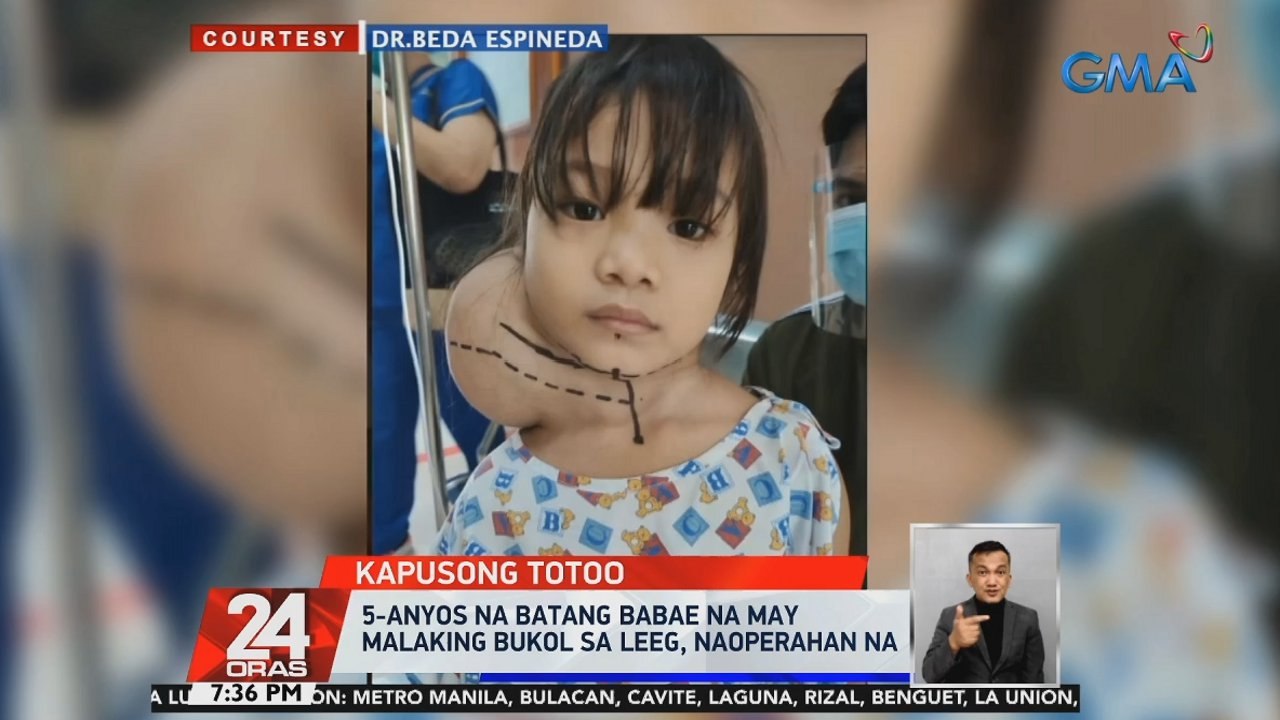 5-anyos na batang babae na may malaking bukol sa leeg, naoperahan na  | 24 Oras