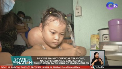 5-anyos na may cervical teratoma,napaoperahan ng Kapuso Foundation sa tulong ng isang netizen | SONA