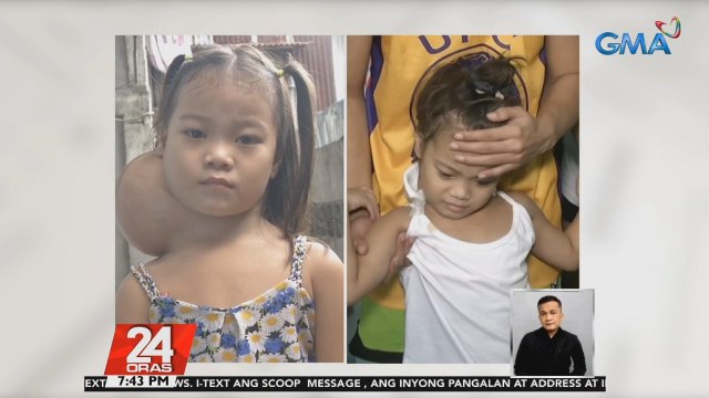 5-anyos na batang may malaking bukol sa leeg, nagpapagaling na matapos ang matagumpay na operasyon | 24 Oras