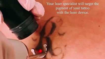 Bodyvie Medi-Clinic: Laser Tattoo Removal