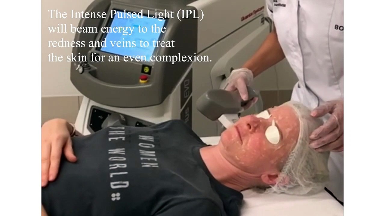 Bodyvie Medi-Clinic: IPL for Redness and Facial Veins