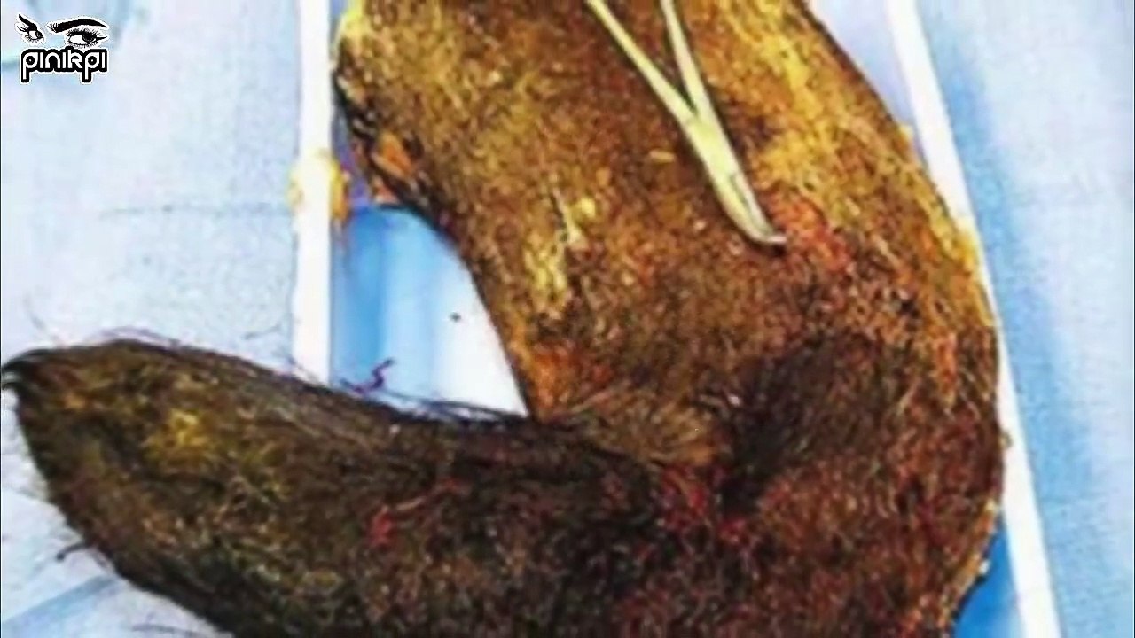 আপনার শরীরের ভিতরেও এই ভয়ংকর প্রাণীগুলো থাকতে পারে। 10 Shocking Creatures Found