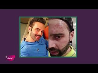 سعود بو شهري يكشف عن تشوه وجهه بسبب الحسد : فنانة حسدتني! واطلالة حليمة بولند تثير الجدل