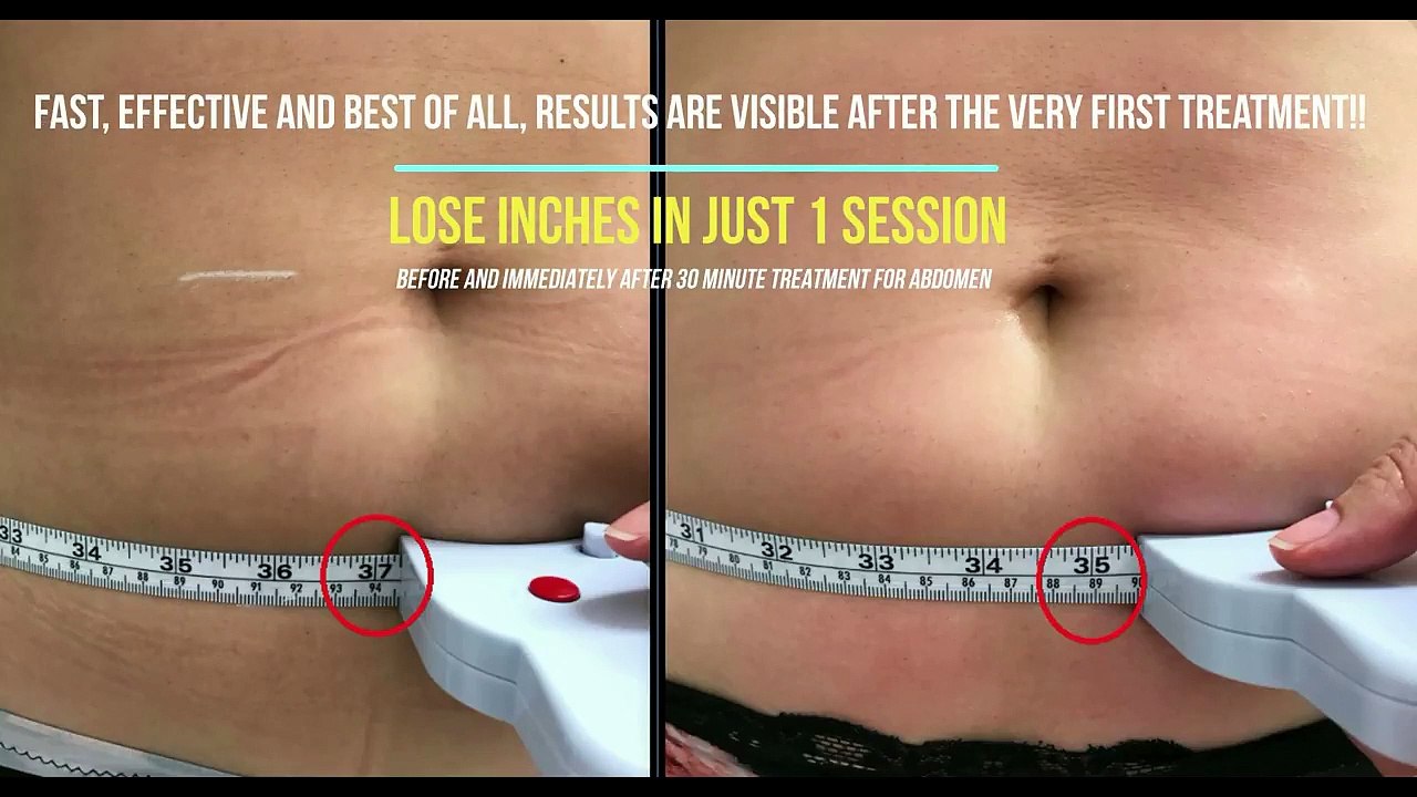 Lipofirm Pro at Bodyvie Medi-Clinic
