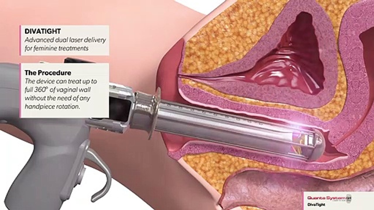 Vaginal Rejuvenation - The Procedure Bodyvie Clinic Richmond HD