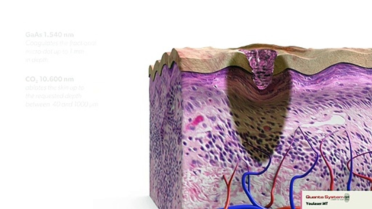 Skin Resurfacing Mixed Technology Overview Bodyvie